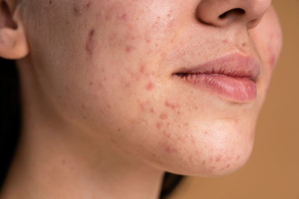 Dermofarmacia - problemas de piel grasa o acnéica